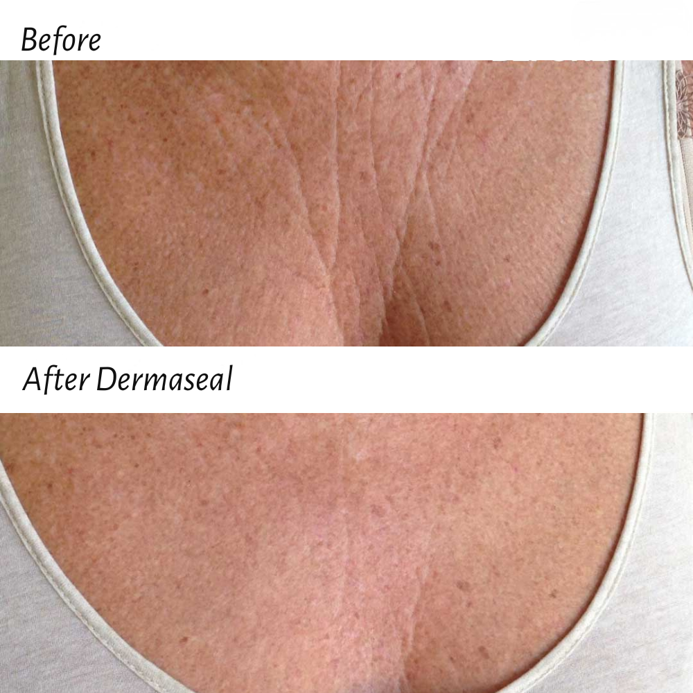 DermaSeal™  Forehead Patch